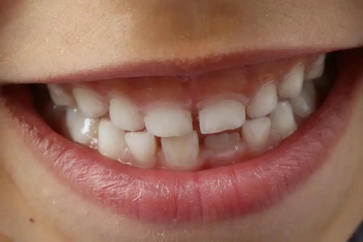 Close-up of smiling mouth showing dental veneers and whitened teeth