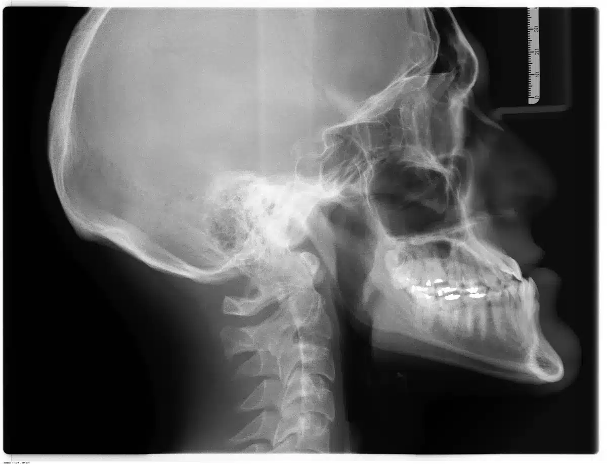 MRI brain scan showing lesion and surrounding tissue
