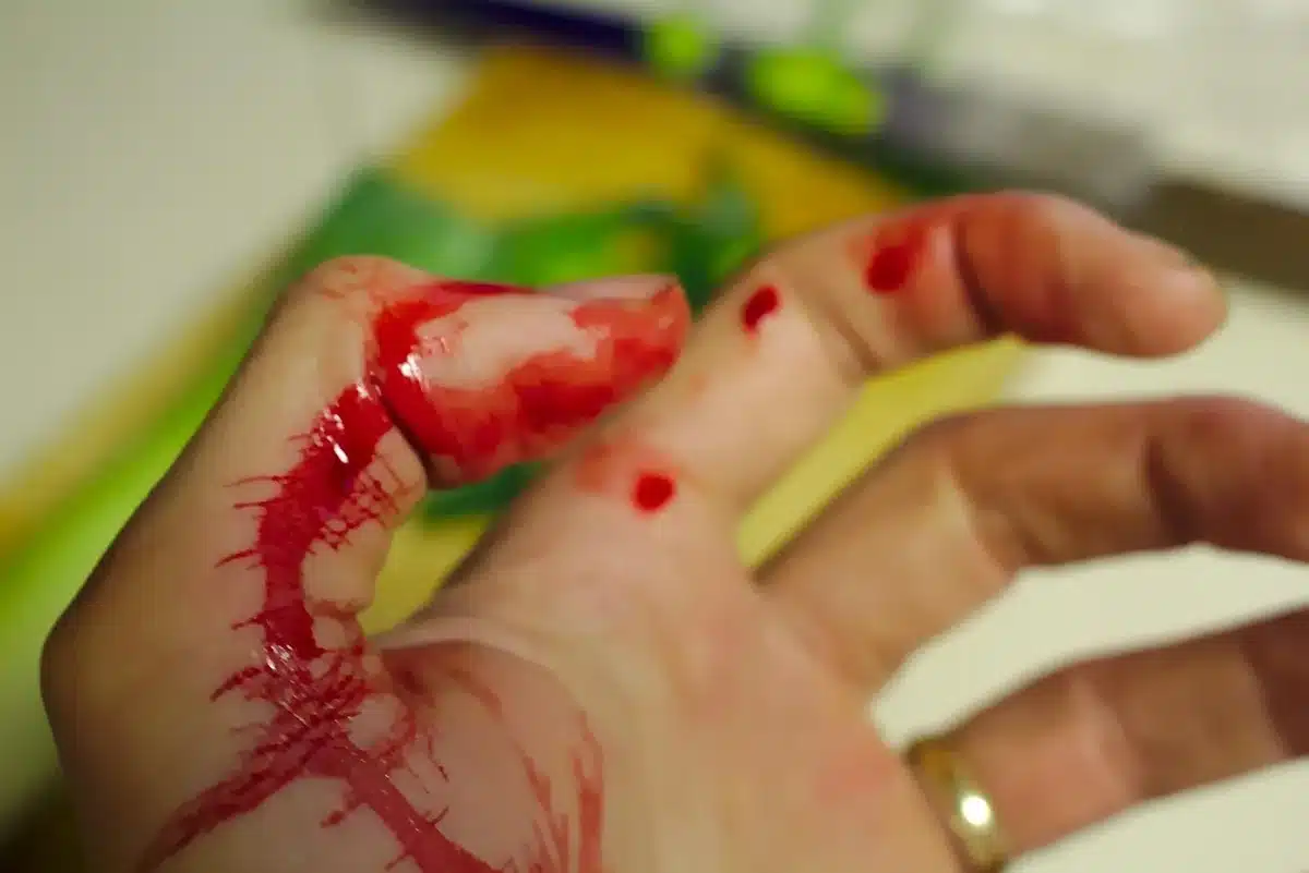 Clinician examining an inflamed bite on an anonymous patient's leg